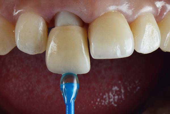 How A Tooth Is Prepared To Have A Dental Crown Restoration