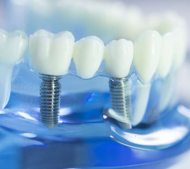 Union City Dental Implants