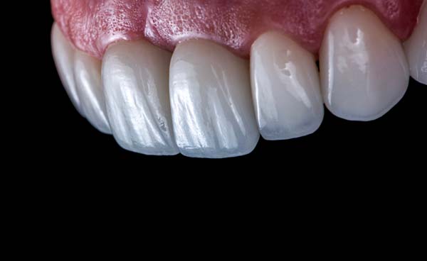 Maintenance Tips For Your Dental Veneers