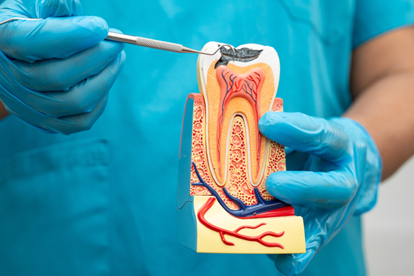 FAQs About Root Canal Treatment